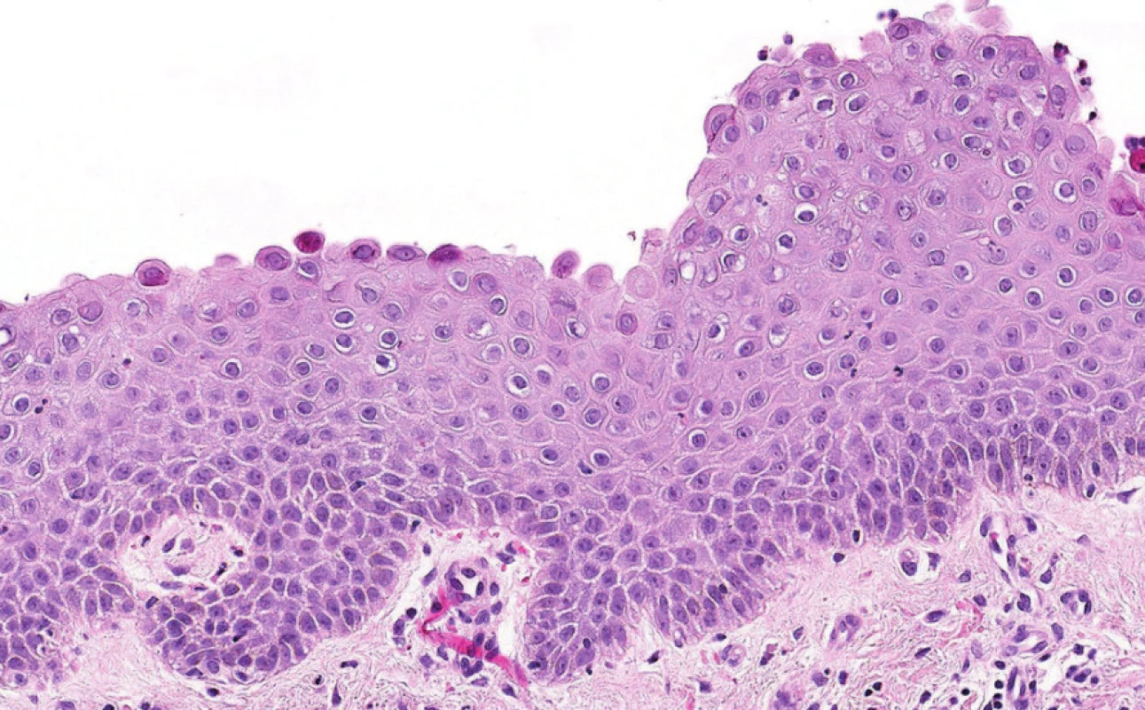 Detailní obraz bulózních změn při IgA pemfigu zachycující akantolytické buňky ve spodině (jak se rozpadají).