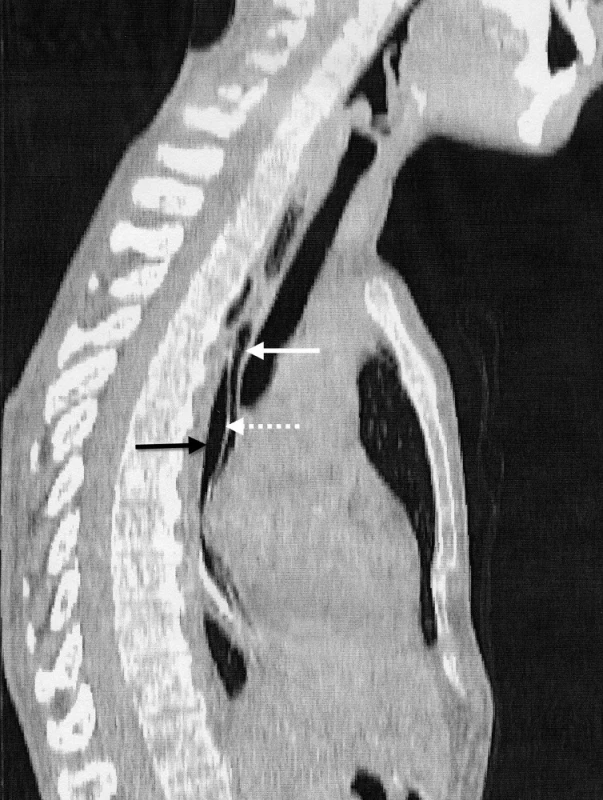 Sagitálna rekonštrukcia druhej kazuistiky Pravý lumen (biela plná šípka), falošný lumen (čierna šípka), septum z mukózy (biela bodkovaná šípka).
Fig. 4: The intramural esophageal dissection A CT scan (sagittal reconstruction) of the second case showing the true lumen (a black solid arrow), the false lumen (a white solid arrow), the mucosal septum (a white dotted arrow).
