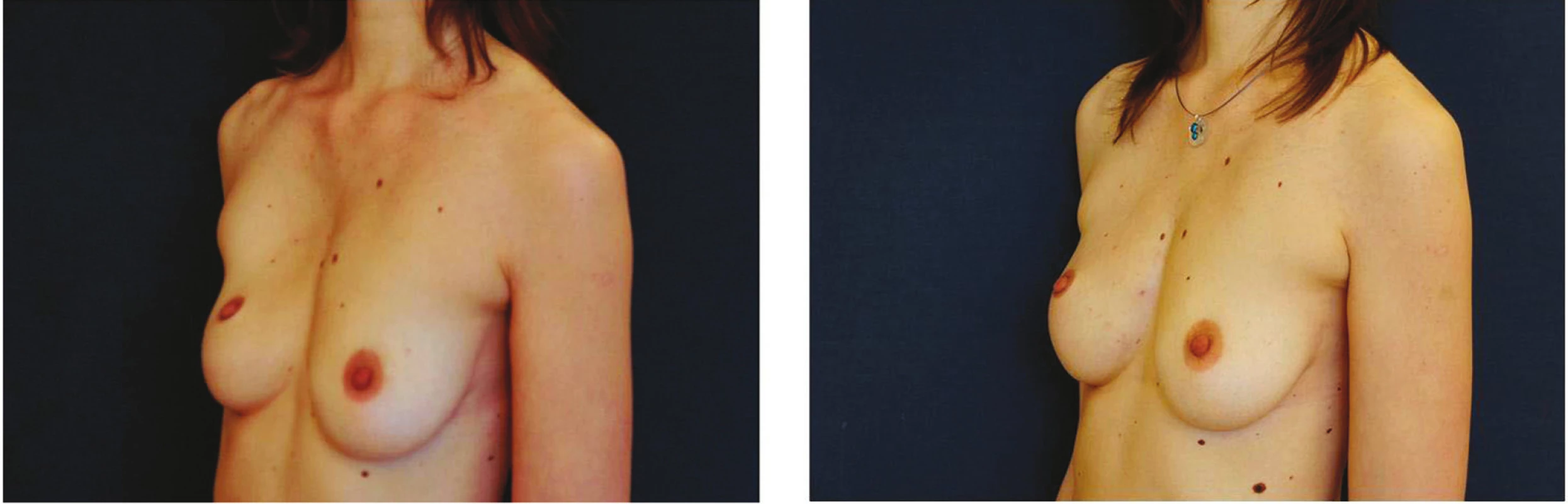 Pacientka s deformitou hrudního koše; před a 3 měsíce po korekci fatgraftingem
Fig. 4: Patient with chest deformity before and three months after reconstruction using fat graft
