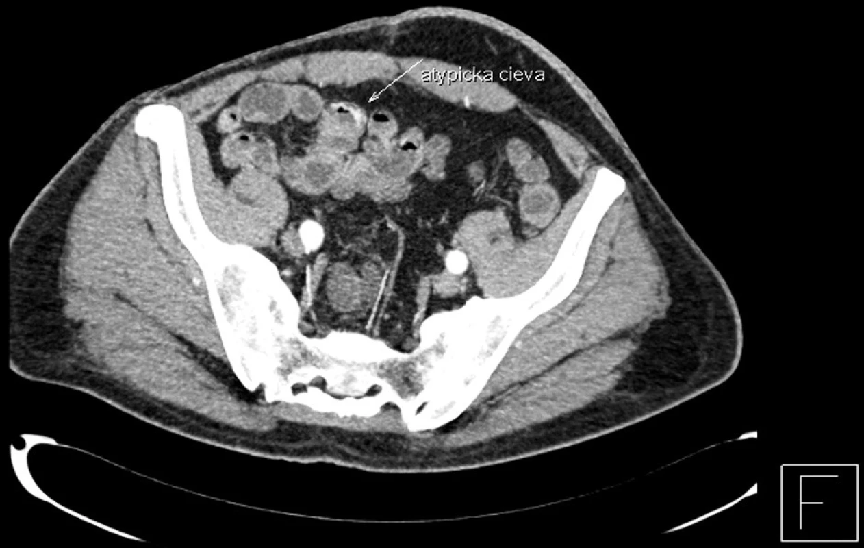 CT enterografia – snímok zachytávajúci cievnu malformáciu na terminálnom ileu (transverzálny rez)
Fig. 2. CT enterography – a view depicting a vascular malformation in the terminal ileum (transverse section)