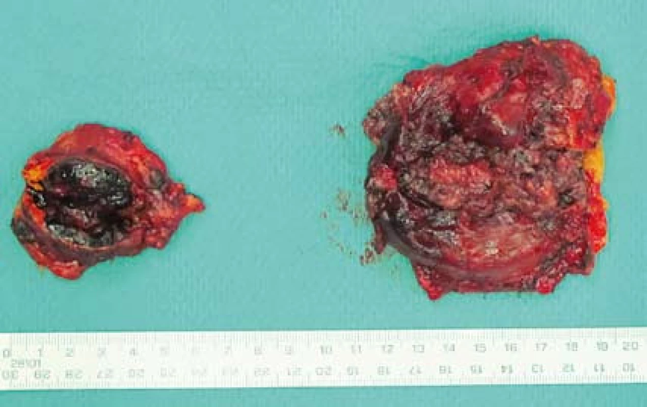 Preparát – tumorózně postižené nadledviny.
Fig. 4. Specimen – tumour affected adrenals.
