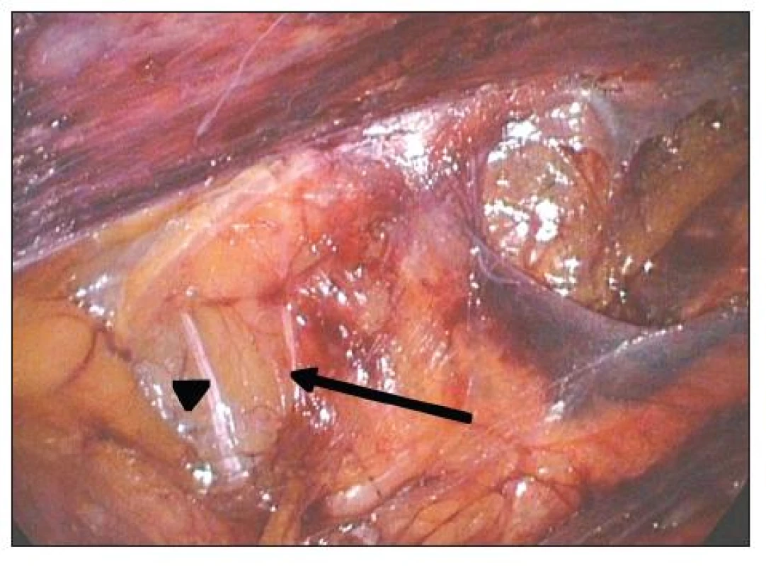 TAPP levého třísla. Mediálně (šipka) je r. femoralis n. genitofemoralis, laterálně (špička šipky) je n. cutaneus femoris lateralis
Fig. 3. TAPP of the left groin. R. femoralis n. genitofemoralis is located medially (arrow), n. cutaneus femoris lateralis is located laterally (arrowhead´s tip)