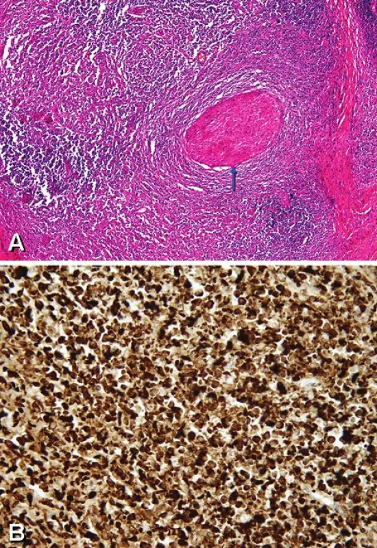„Zánětlivý pseudotumor orbity“: (A) Intenzivní lymfoplazmocelulární zánětlivý infiltrát obklopující nerv (oválná struktura napravo od středu, šipka) a fibróza (vazivový pruh) vpravo (HE, zvětšeno 100). (B) Pozitivní imunohistochemický průkaz IgG4 ve formě hnědého zabarvení cytoplazmy plazmatických buněk (zvětšeno 400).
