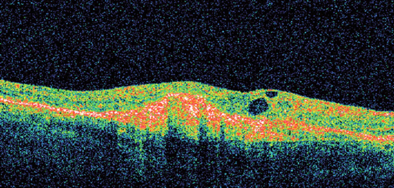 Optická koherenční tomografie – vlhká forma VPMD.
