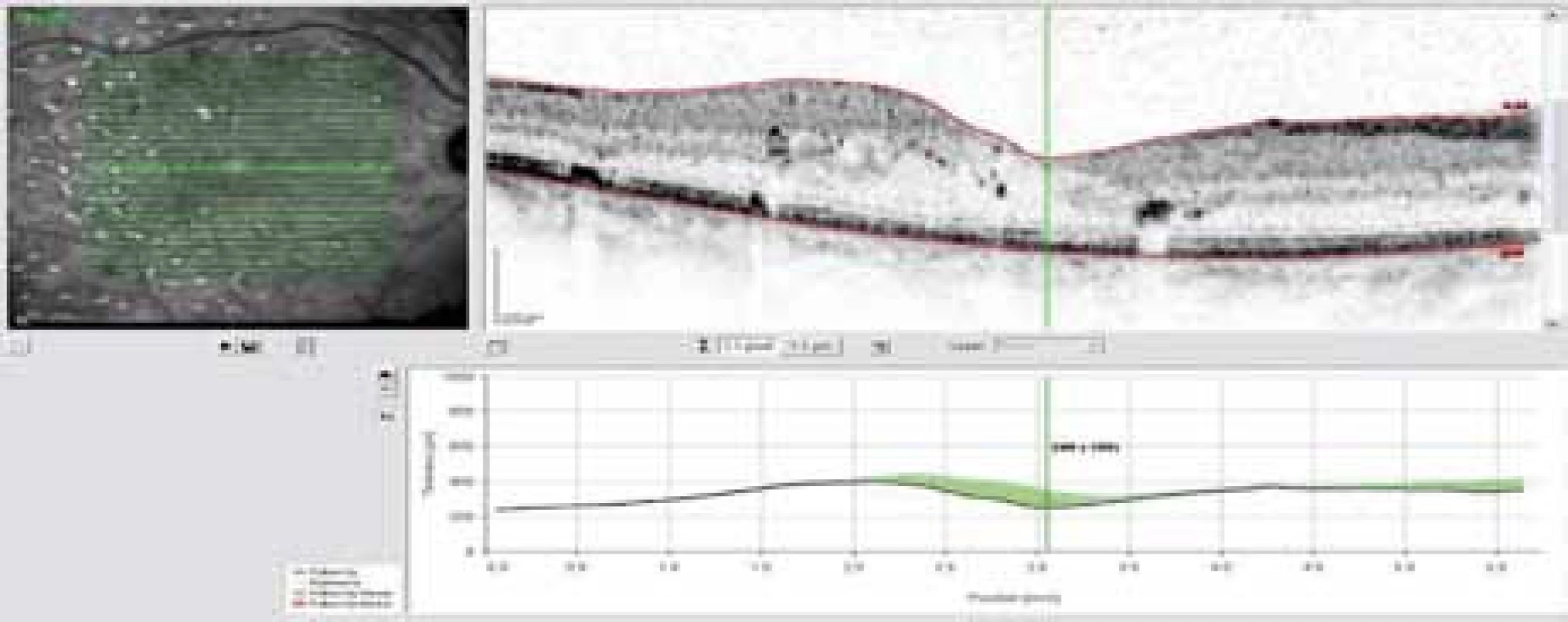 OCT snímek – ústup edému sítnice v makule za 2 měsíce od injekce Lucentisu.
