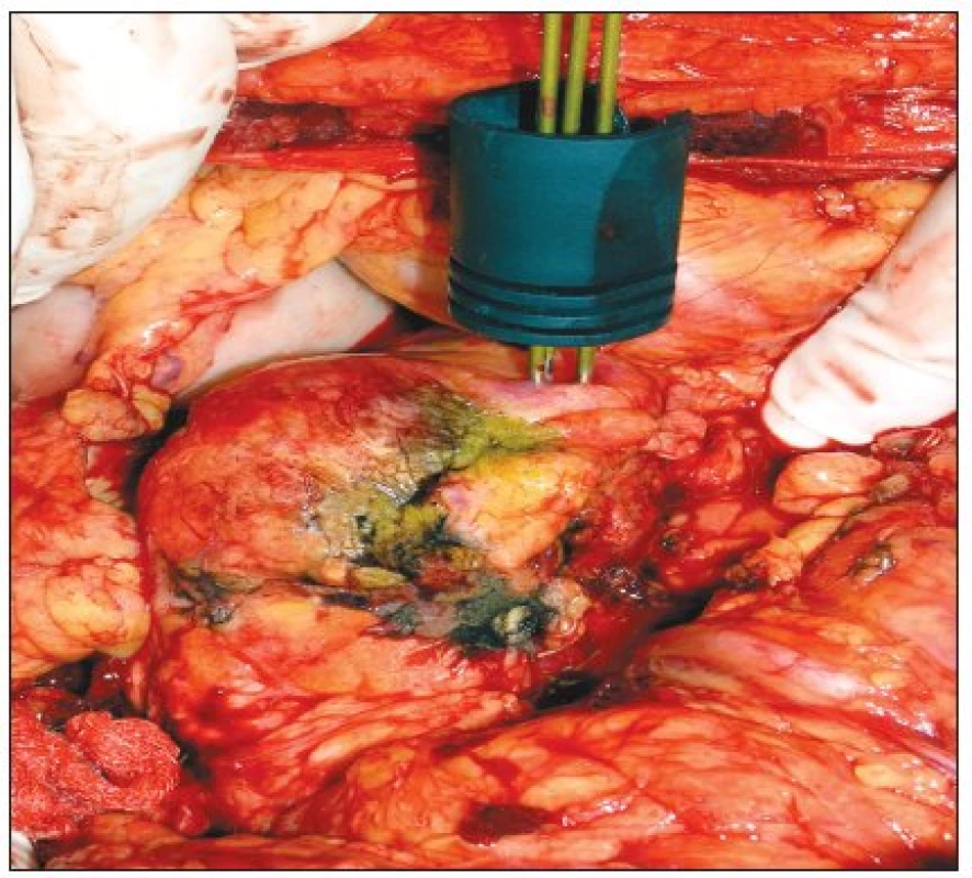RFAmaligního neuroendokrinního tumoru těla pankreatu pomocí cluster elektrody
Fig. 1. RFA of a malignant pancreatic neuroendocrine tumor, using a cluster electrode.