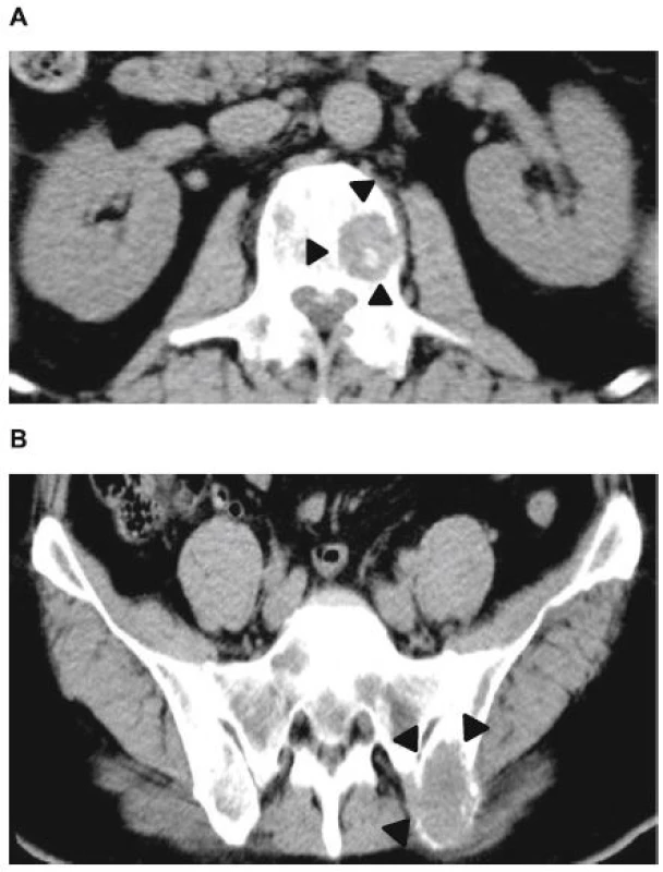 Non-contrast abdominal computed tomography (CT) images. a: Multiple bone masses; b: Multiple bone masses (black arrowheads) from the abdominal area