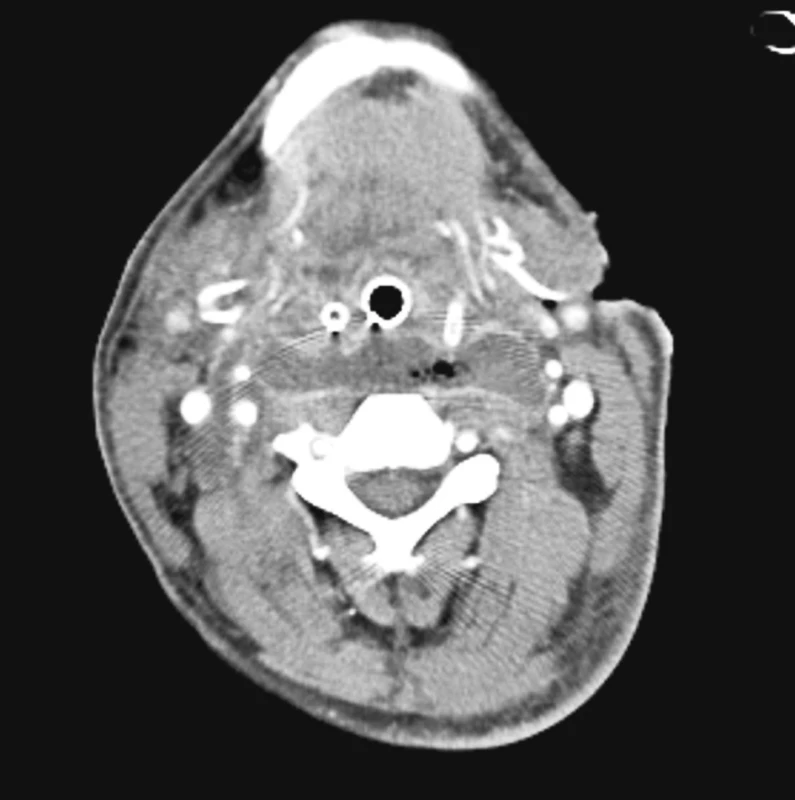 Axiální obraz CT s prevertebrálním abscesem
Fig. 1. Axial CT view depicting a prevertebral abscess