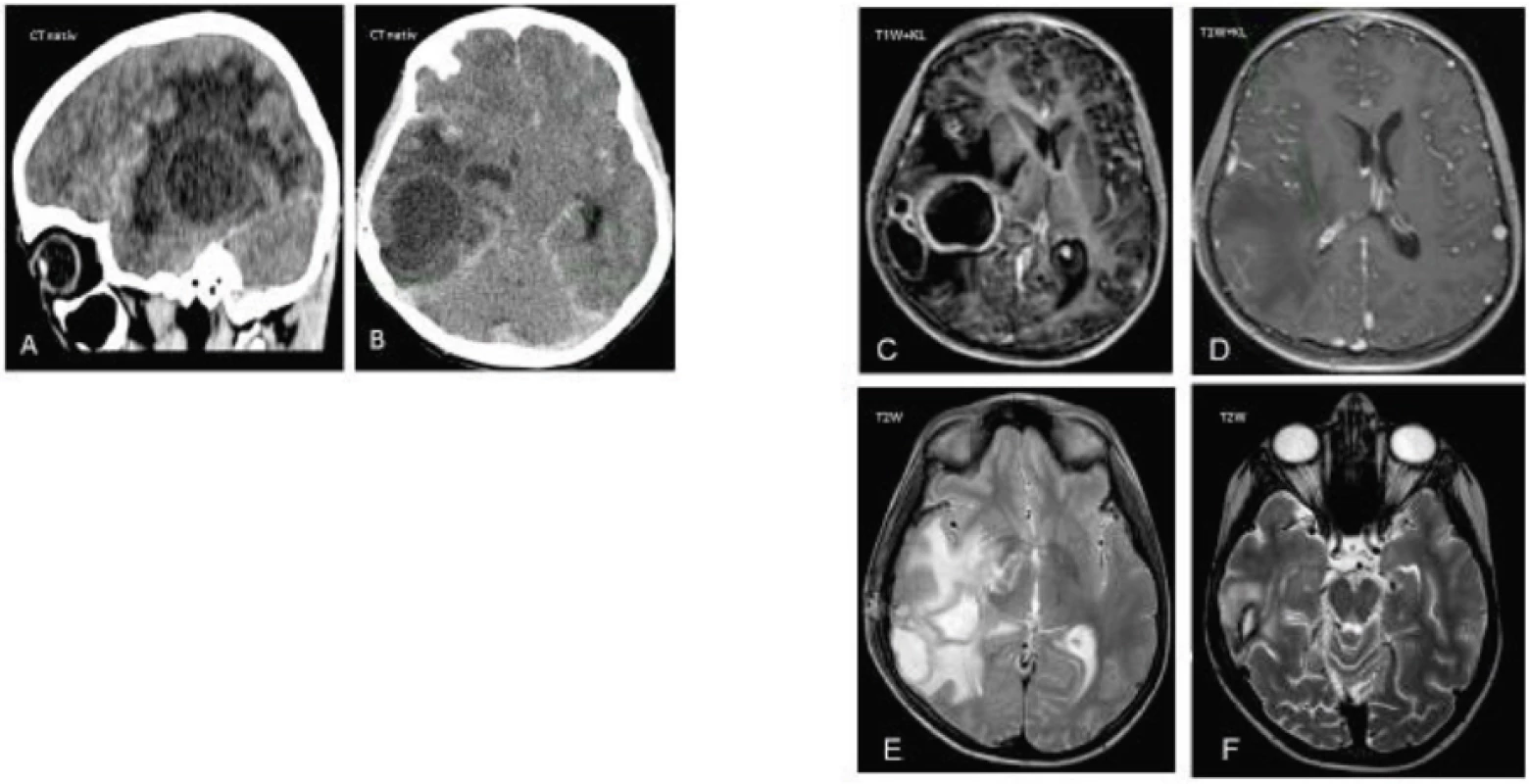 CT a MRI mozgu s početnými abscesmi u pacienta č. 2.
A–B. V natívnom CT obraze sa zobrazuje 5 abscesových ložísk v pravej hemisfére s hlavným ložiskom temporo-fronto-okcipitálne vpravo veľkosti 38 x 36 x 42 mm, s perifokálnym edémom a presunom stredových štruktúr, s leptomeningitídou a známkami intrakraniálnej hypertenzie.
C–F. MRI v T1W s kontrastom zobrazuje 4 abscesové ložiská.
E. Supratentoriálne temporálne vpravo reziduálna abscesová dutina, parciálne kolabovaná.
Fig. 2. CT and MRI of multiple absceses in a case 2.
A–B. CT scans demonstrate 5 abscesses in a right hemisphere. The largest abscess is located in the right temporo-fronto-occipital area in diameter 38 x 36 x 42 mm, a perifocal edema, a leptomeningitis and the signs of a intracranial hypertension are present. The right frontal lobe of brain is shifted across the midline.
C–F. T1-weighted MRI images with a gadolinium contrast demonstrate 4 abscesses.
E. A residual abscess cavity located within the right temporal area is partially collapsed