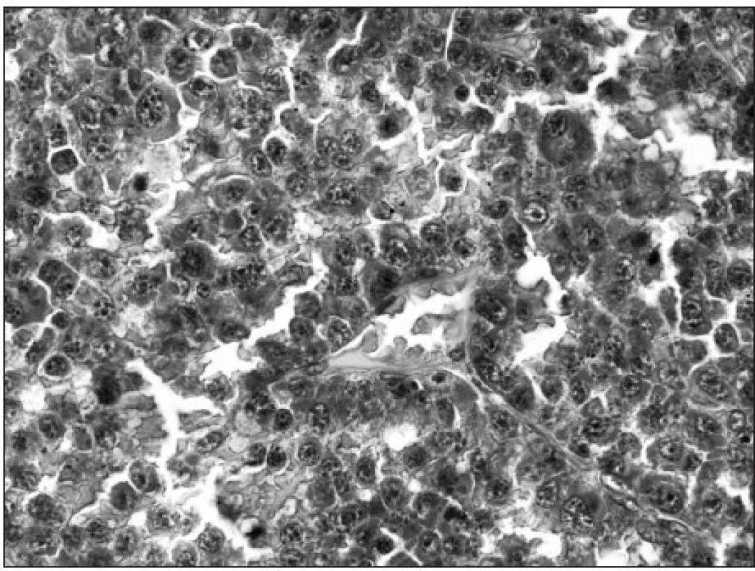 Pseudorozetovité řazení nádorových buněk kolem kapiláry, HE 600krát