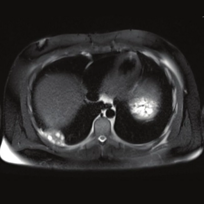 MRI, T2 weighted image, axial plane: lung involvement.