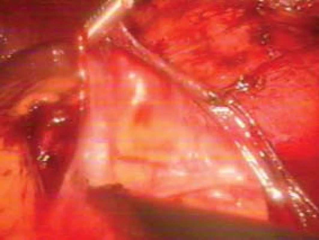 Otevření Gerotovy fascie při laparoskopické adrenalektomii.