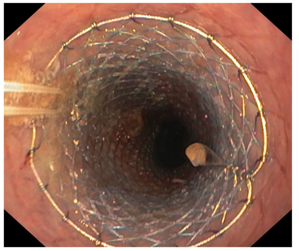 Endoskopický obraz zavedeného zavěšeného jícnového
stentu<br>
Fig. 4: Endoscopic image of an inserted suspended esophageal
stent
