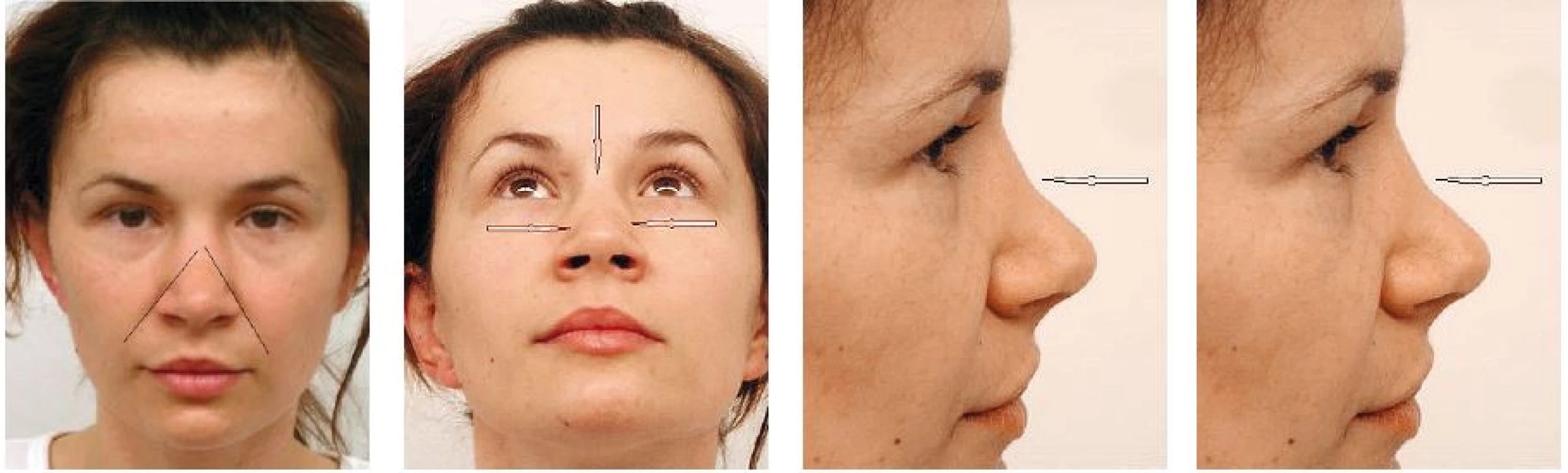 Deformita nosa v tvare obráteného písmena „V“. Pacientka niekoľko rokov po rinoplastike, vľavo čiarou je naznačené pokračovanie nazolabiálnej ryhy smerom na dorzum nosa. Na ďalšej snímke je šípkami vyznačená priehlbina tvoriaca podstatu deformity. Pravé snímky demonštrujú pokles profilovej línie na rozhraní strednej a hornej tretiny nosa.