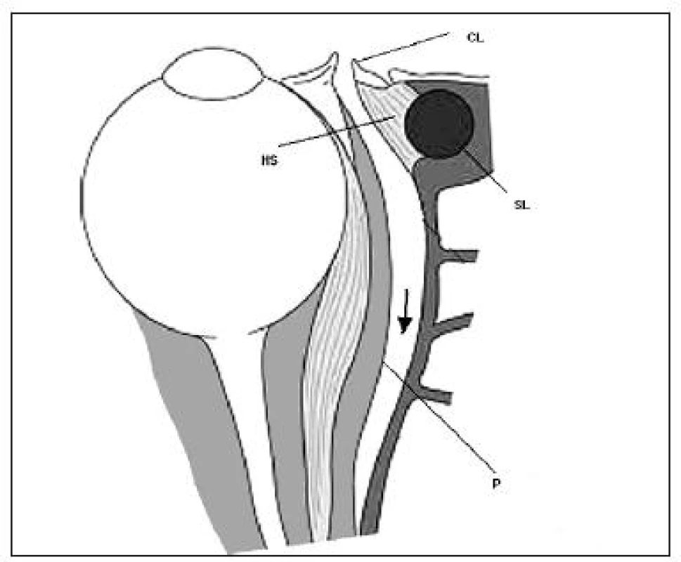 Transkarunkulárna mediálna orbitotómia. Disekcia medzi karunkulou a plica semilunaris so šetrením mediálneho palpebrálneho ligamenta a slzného vaku (šípka) CL- caruncula lacrimalis (rozdelená), SL- saccus lacrimalis, HS- Hornerov sval , P- periorbita (voľne podľa Lai et al., 2003)
