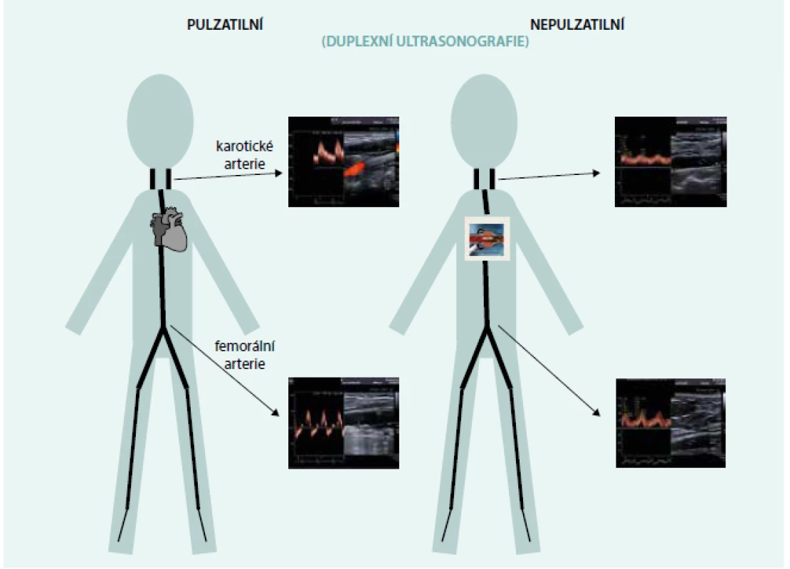 Charakteristika průtoků měřená ultrasonografickým dopplerovským vyšetřením u osoby bez mechanické srdeční podpory (vlevo) a se srdeční podporou (vpravo)