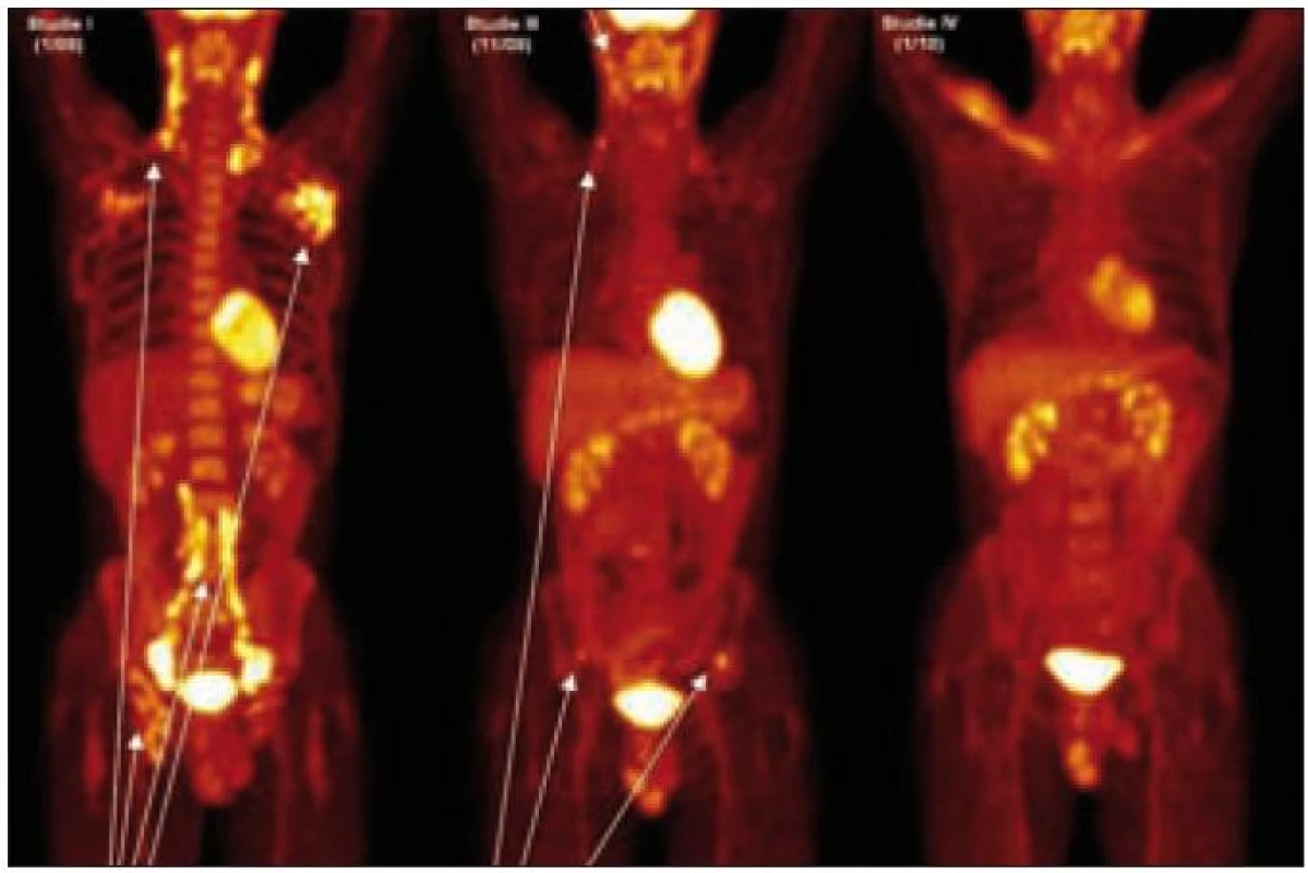 PET-CT u muže narozeného roku 1973 s průběhem nemoci podobným lymfomu a s plicním postižením. Na prvním obrázku vlevo, vyšetření před léčbou, je velmi dobře zřetelná patologicky zvýšená aktivita v oblasti krčních, axilárních, ilických a tříselných uzlin, ale nebylo zřetelné poškození kostí. Na prostředním obrázku, který byl proveden v době relapsu 2 měsíce po ukončení léčby 2-chlorodeoxyadenosinem, je zřetelná patologicky zvýšená aktivita v oblasti krčních uzlin a dále v oblasti lopat kosti kyčelní, kde na low dose CT byla prokázána osteolytická ložiska. Na obrázku vpravo je vyhodnocení účinnosti léčby po dvou cyklech CHOEP a zde není zřetelná žádná patologická akumulace fluorodeoxyglukózy.