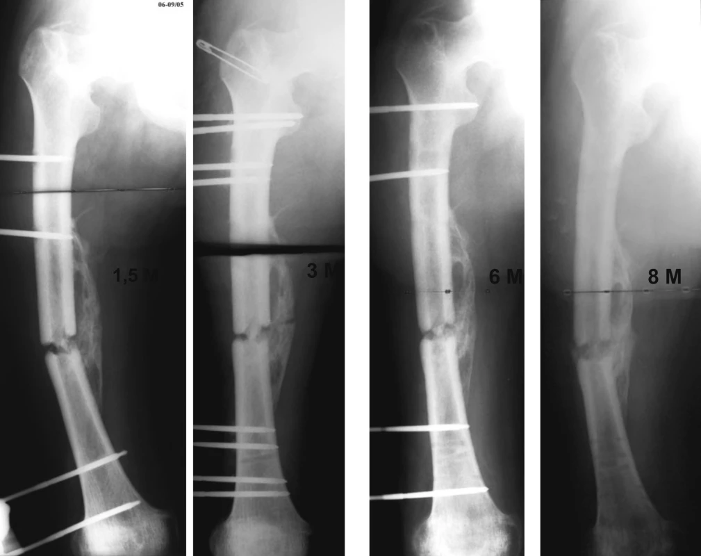 Control X-ray of right femur 1.5, 3, 6 and 8 months after the injury