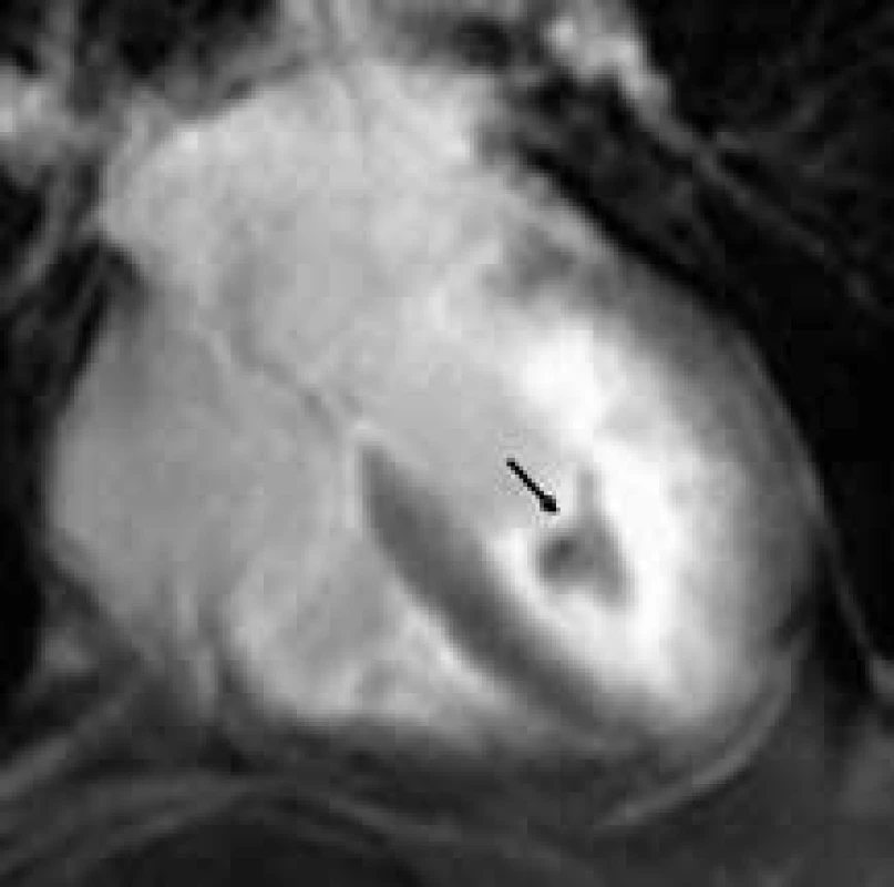 Difuzní subendokardiální pozdní sycení kontrastní látkou (LGE) apikální poloviny až dvou třetin levé komory s centrálním hyposignální oblastí odpovídající trombu (černá šipka) u nemocného s endomyokardiální fibrózou;