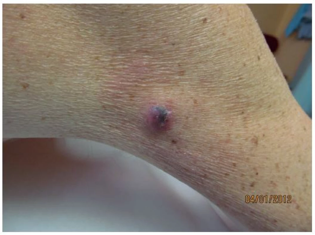 Klinický nález nodulárního melanomu
