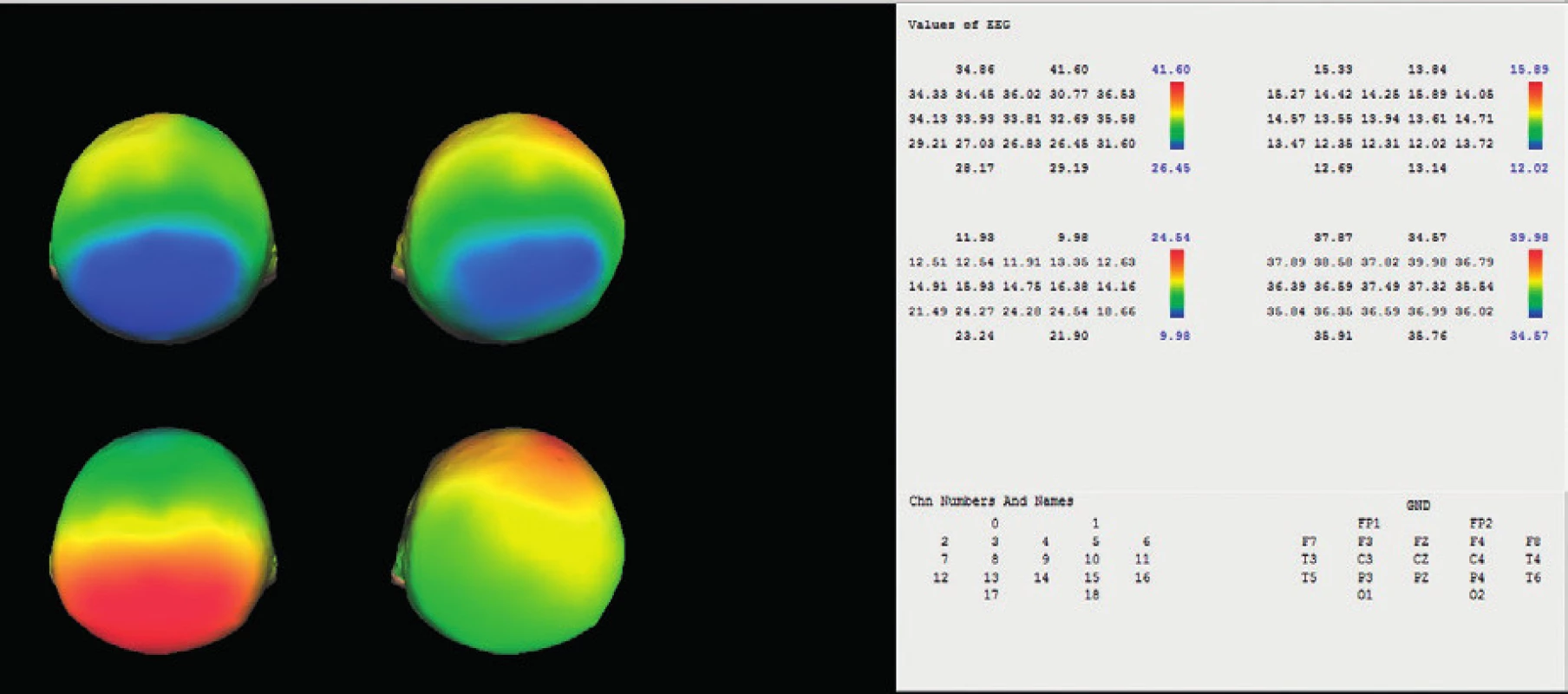 Frekvenční brain mapping s číselnými hodnotami pro delta, theta, alfa a beta.