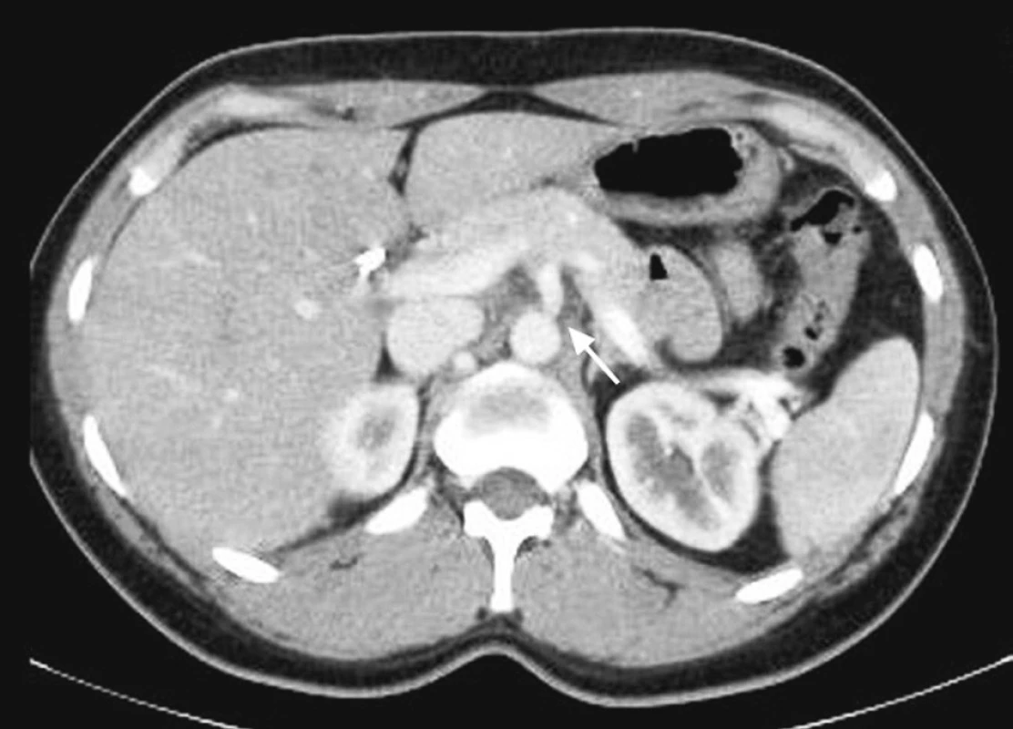 CT vyšetření s bolusem kontrastní látky intravenózně v arteriální fázi zaměřené na odstup truncus coeliacus, kde je patrná krátká stenóza
Pic. 4. CT scan with arterial phase enhancement focused at the celiac axis shows a short stenosis