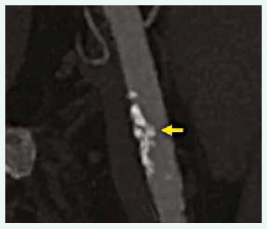 CT zobrazení technikou MIP (Maximal Intensity Projection) s nálezem pokročilé aterosklerózy v oblasti levé a. femoralis communis (šipka). 