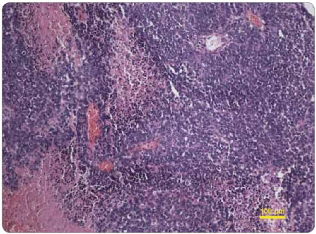 Histologický obraz tumoru hrudní stěny z ledna 2011, barvení hematoxylineozin, původní zvětšení 100×. Solidně rostoucí denzně celulární nádor ze středně velkých okrouhlých buněk imituje jiné nádory „z malých okrouhlých modrých buněk“, např. rhabdomyosarkom. V levé části snímku jsou patrné růžově zbarvené oblasti koagulačních nekróz.