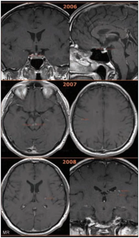 Postižení CNS u pacienta s Erdheimovou-Chesterovou chorobou zobrazené na MR mozku v T1 vážené sekvenci po aplikaci kontrastní látky.

2006: koronární (vlevo) a sagitální (vpravo) rovina. Postkontrastně se sytící ložiskové zbytnění stopky hypofýzy na 4–5 mm u pacienta s příznaky diabetu insipidu. (Normální stopka hypofýzy se nálevkovitě zužuje, v úrovni chiasma opticum měří kolem 3 mm a při vyústění do hypofýzy jen 1– 2 mm [3].) Byla provedena endoskopická stereotakticky navigovaná parciální resekce stopky hypofýzy, dle histologického vyšetření byl však nález nespecifický a odpovídal lymfoidní zánětlivé infiltraci v oblasti hypofýzy. Absenci morfologie typické pro Erdheimovu-Chesterovu chorobu (pěnité makrofágy, mnohojaderné obrovské buňky Toutonóvy, fibroblastické pozadí) popisují i jiní autoři a její příčina není dosud objasněna. Analogii lze hledat u pacientů s neurodegenerativními projevy histiocytózy z Langerhansových buněk, u nichž byly i sekčně nalezeny pouze lymfocytární infiltráty. Bylo spekulováno, že celé neurodegenerativní poškození může mít podklad maligní chorobou indukované degenerativní změny. Je tedy možné, že infiltrace CNS pěnitými histiocyty provází natolik intenzivní zánětlivá reakce, že cílené biopsie nemusí diagnózu Erdheimovy-Chesterovy choroby odhalit, a někteří autoři proto doporučují při diferenciální diagnostice infiltrace stopky hypofýzy vždy vyšetření dolních končetin, zda nejsou přítomny znaky charakteristické pro ECD [3,11,12].

2007: transverzální roviny. Vlevo patrná nová ložiska v mesencephalu s postkontrastně se sytícím centrem a cirkulárním jemným lemem kolaterálního edému, vpravo pak tečkovité ložisko subkortikálně.

2008: transversální (vlevo) a koronární (vpravo) rovina. Nová ložiska v oblasti levého zadního raménka kapsuly interny. U pacienta se projevila nová neurologická symptomatika ve formě dysartrie středního stupně, reflexologická převaha na pravé dolní končetině a porucha alternujících pohybů levé ruky.