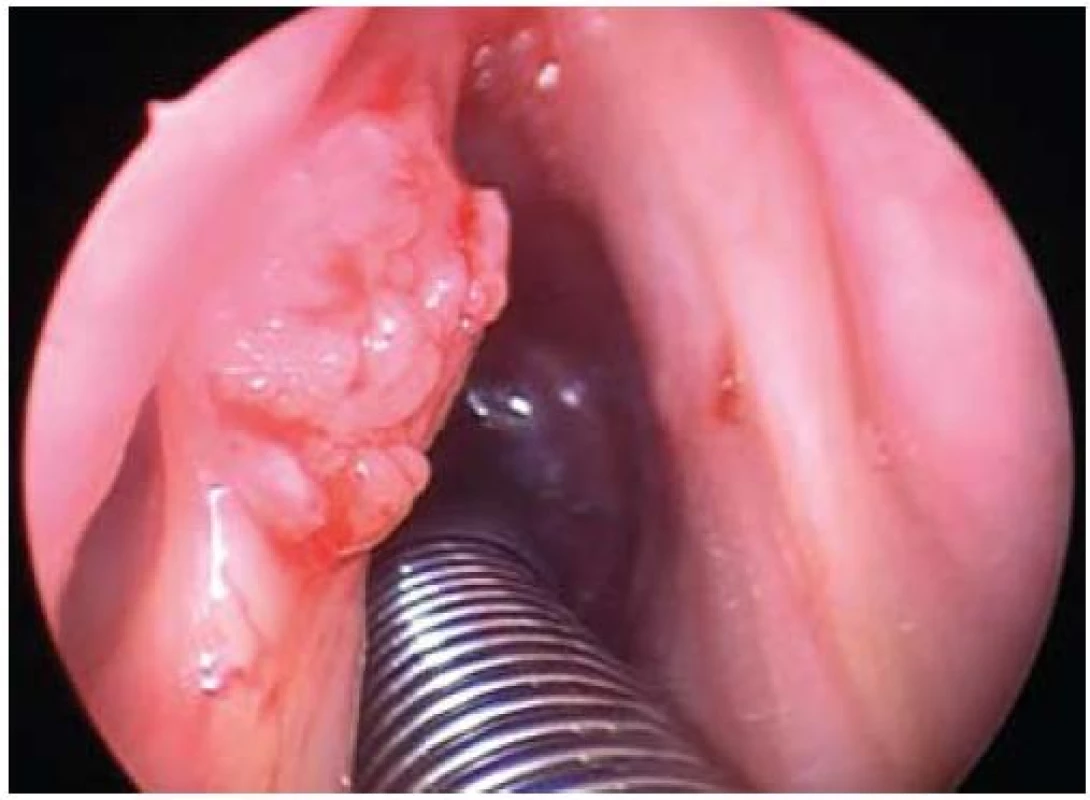 Karcinom levé hlasivky stadia T1.
Fig. 2. T1 carcinoma of the left vocal cord.