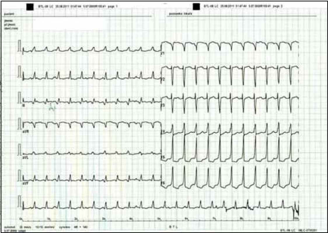 EKG záznam po elektrické kardioverzi.