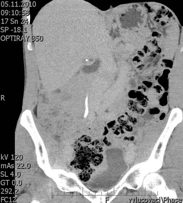CT obraz – následující řez, patrný konkrement v jednom cystickém útvaru
Fig. 2: Following CT image – visible concrement in one cystic lesion