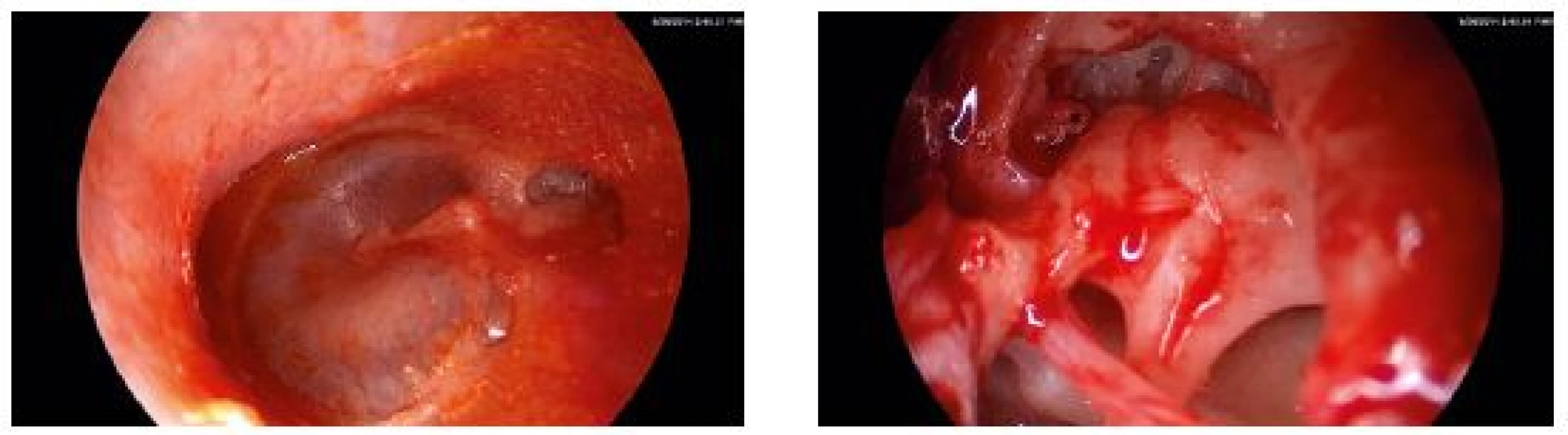 Pacient SC, 25 let, levé ucho. Endoskopicky zjevný zbytek stěny retrakční kapsy 3. stupně dle Tose v protympanu (*).