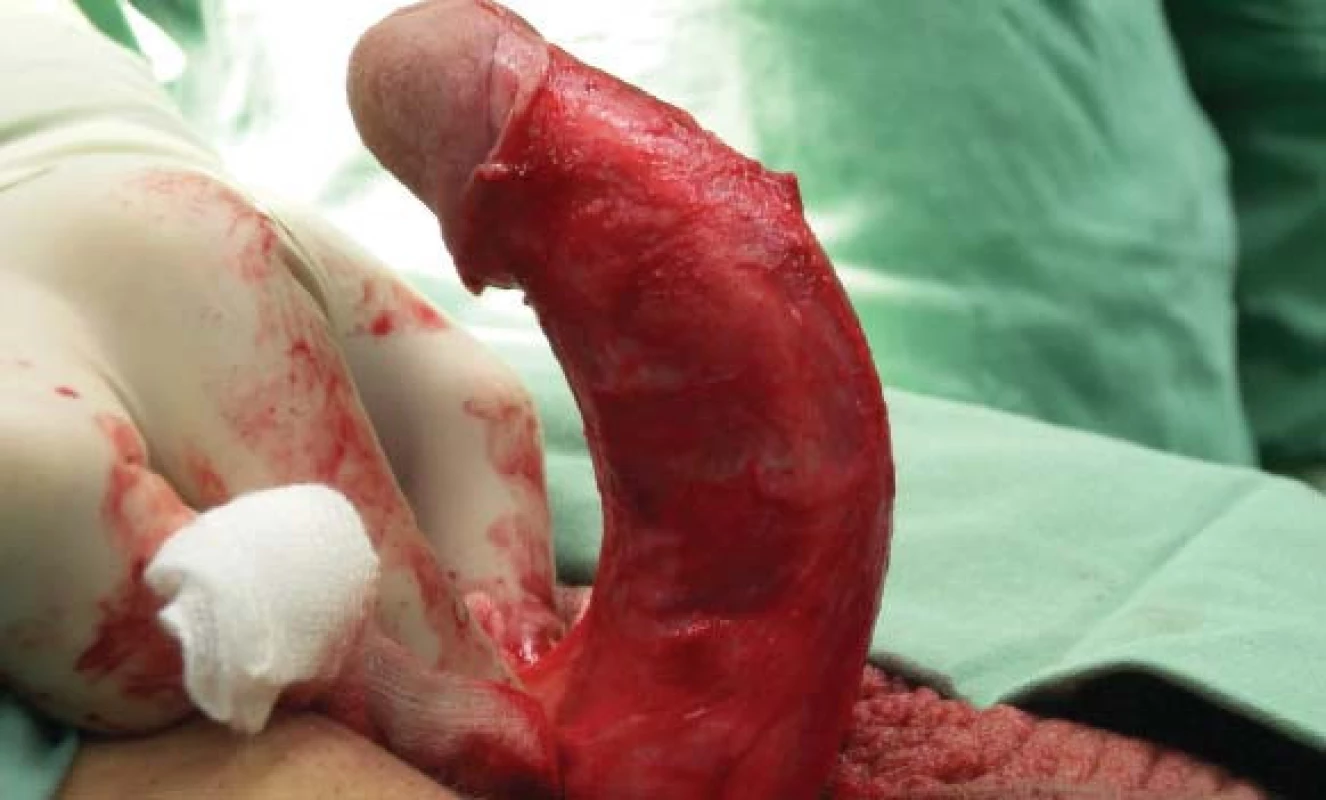 Dorzální angulace dekapitovaného penisu.