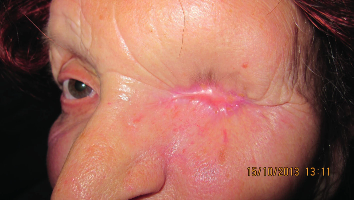 Priebeh hojenia dutiny očnice – 1 rok od exenterácie, bez recidívy (10/2013).