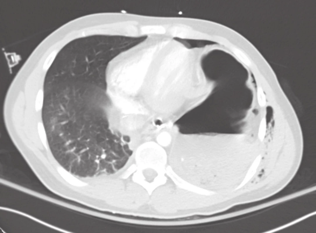 CT nález u levostranné ruptury bránice
Fig. 3: CT finding of left-sided diaphragmatic rupture