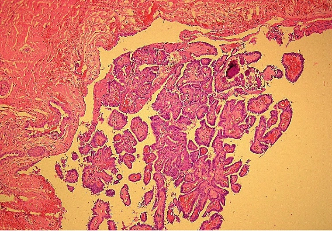 Papilární karcinom v mediální krční cystě (mikroskopické zvětšení 100x).
