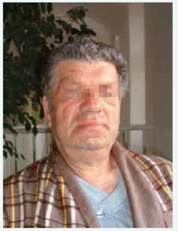 Typický vzhled obličeje pacienta s akromegalií (z archivu autora)