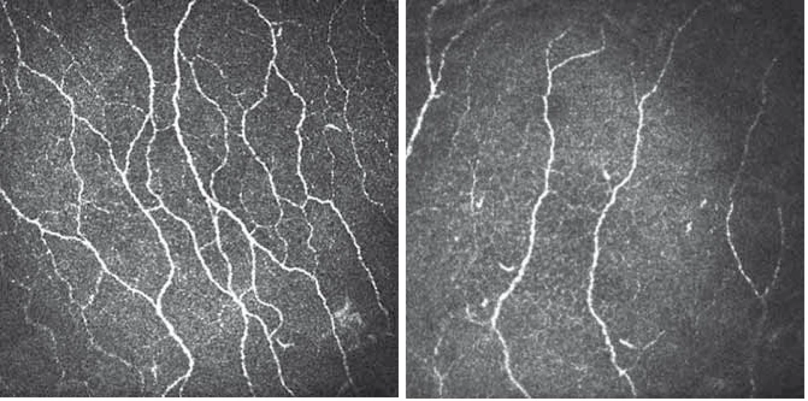 CCM snímky korneálního nervového plexu z centrální části rohovky (zvětšení 700×).
Obr. 3A) Snímek u zdravého dobrovolníka s patrným velkým počtem dobře identifikovatelných paralelně ležících nervových vláken s četnými anastomózami.
Obr. 3B) Snímek u pacienta s DPN zřetelně vyjádřenou redukcí vyšetřovaného nervového plexu.
Fig. 3. CCM image of the nerve plexus in the central part of the cornea (original magnification 700×).
Fig. 3A) Image of a healthy volunteer with high density of nerve fibres and many branches.
Fig. 3B) Image of a patient with DPN with pronounced reduction of fibre density and low number of branches.