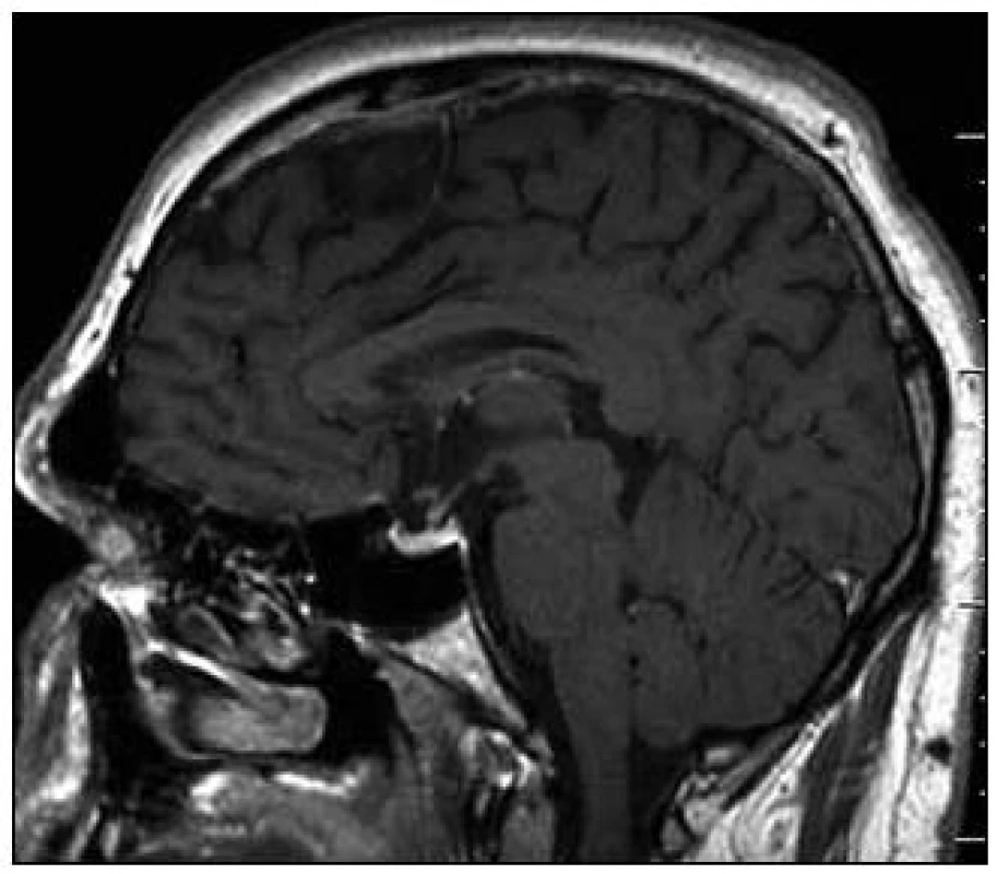 Sagitální rovina MR zobrazení mozku po léčbě, T1 vážený MR obraz po aplikaci k.l. Původní výrazná infiltrace stopky hypofýzy výrazně regredovala, téměř vymizela.ky hypofýzy výrazně regredovala, téměř vymizela.