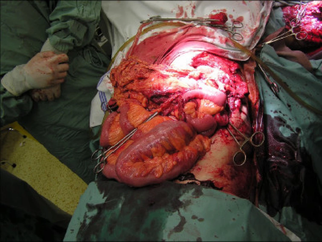 Eviscerace břicha CT orgánu – úrazový snímek