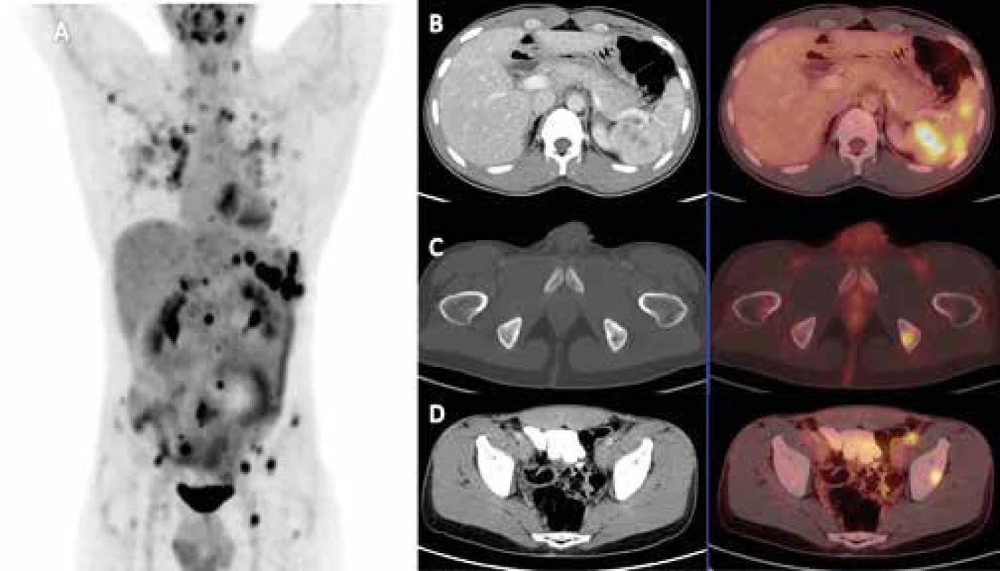 FDG-PET/CT vyšetření pacienta s histologicky prokázanou sarkoidózou