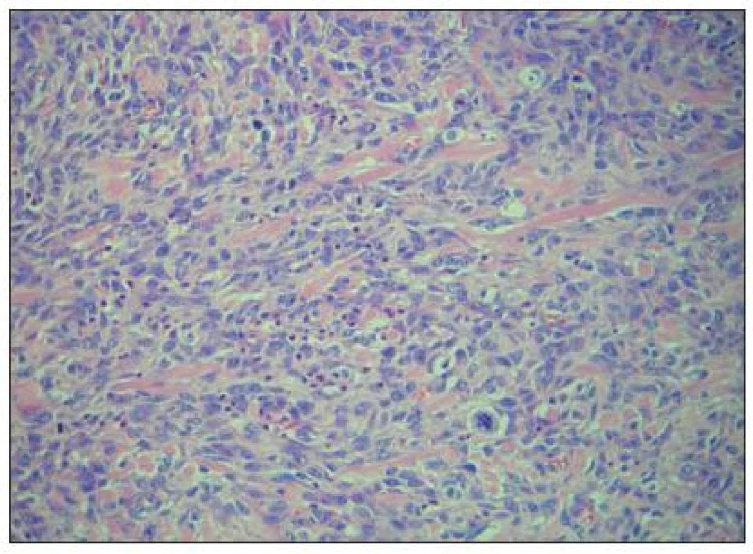 Hypercelulární úsek nádoru z vřetenitých buněk se zachycením četných mitotických figur a s atypickými mitózami, intersticium tvořeno snopci kolagenního vaziva s ložiskovou zánětlivou infiltrací (barveno hematoxylin-eozinem, originální zvětšení 200×)