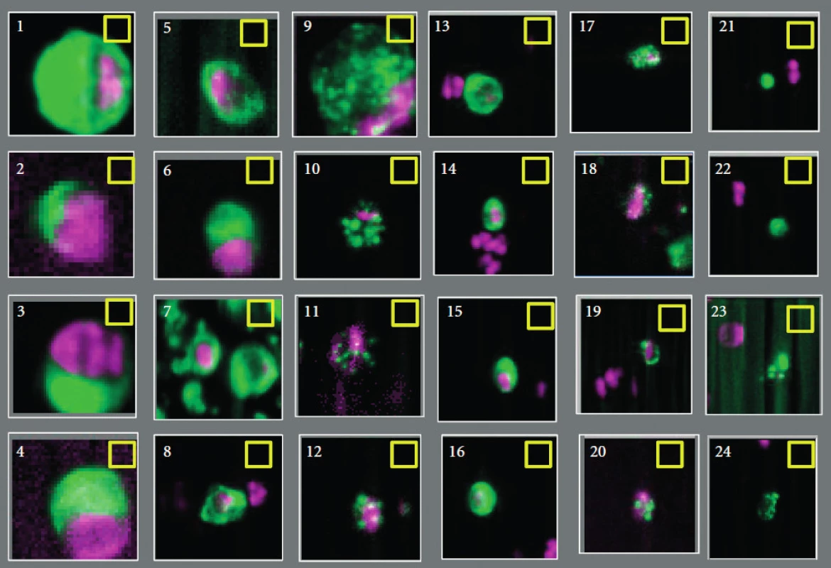Zobrazení možných cirkulujících nádorových buněk pomocí semiautomatického systému CellTracks Analyzer II. Jasně pozitivní jsou č. 1–10 a 13–17, jasně negativní č. 20–24. U zbylých objektů nebyla při hodnocení šesti operátory absolutní shoda (převzato se svolením z Miller et al. (11))