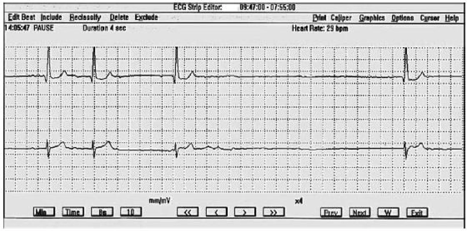 A–V blokáda II. stupňa typu Mobitz I so 4-sekundovou asystolickou pauzou v Holterovskom zázname