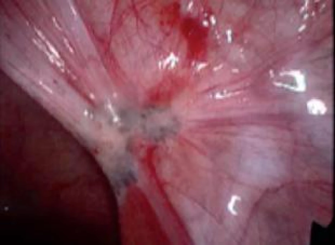Typické ložisko endometriózy v oblasti zadního vazu děložního.