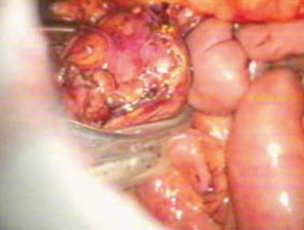 Uložení uvolněného tumoru do orgánového lapsaku.