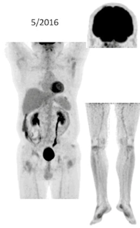 FDG-PET/CT zobrazení v květnu roku 2016 při déle než 5leté léčbě anakinrou
Při low-dose CT zobrazení, které bylo součástí PET/CT vyšetření, zůstávají stále dobře zřetelná četná osteosklerotická ložiska ve skeletu zvláště v dolních končetinách. Akumulace FDG v nich se však po 5 letech léčby snížila