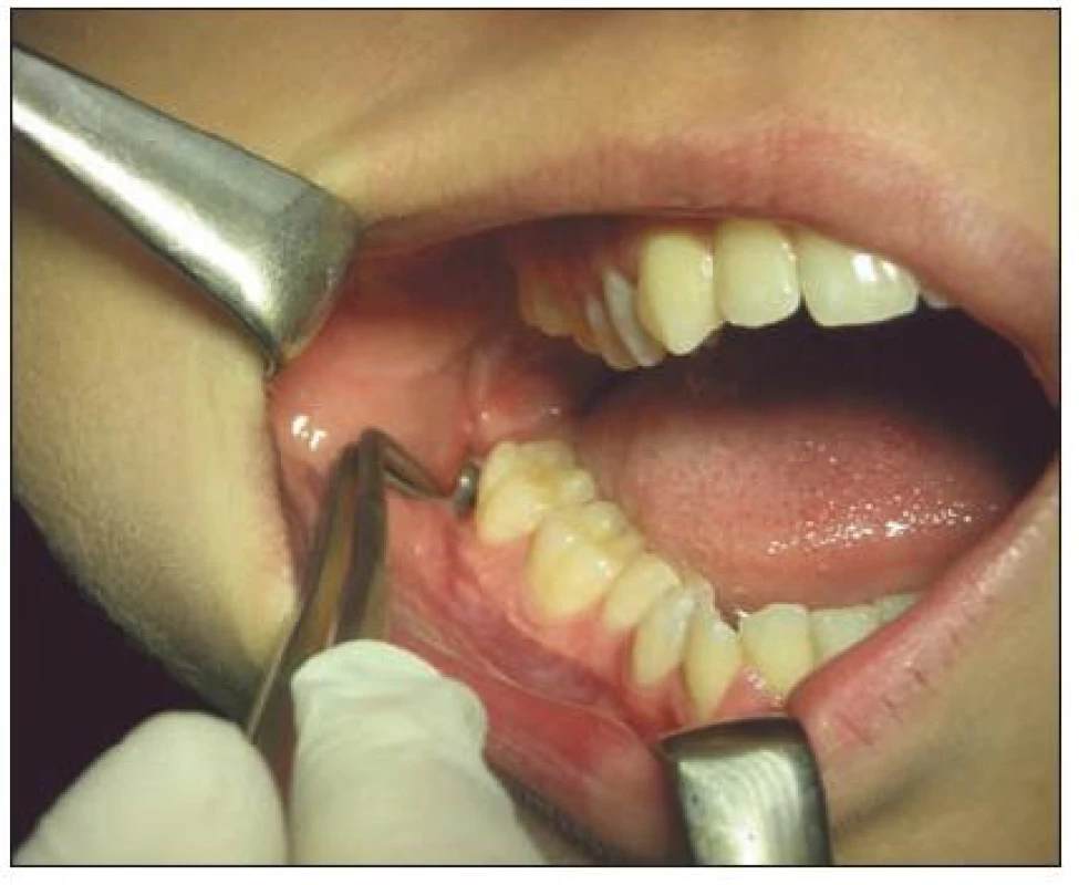 Prázdné zubní lůžko po extrakci zubu 48
