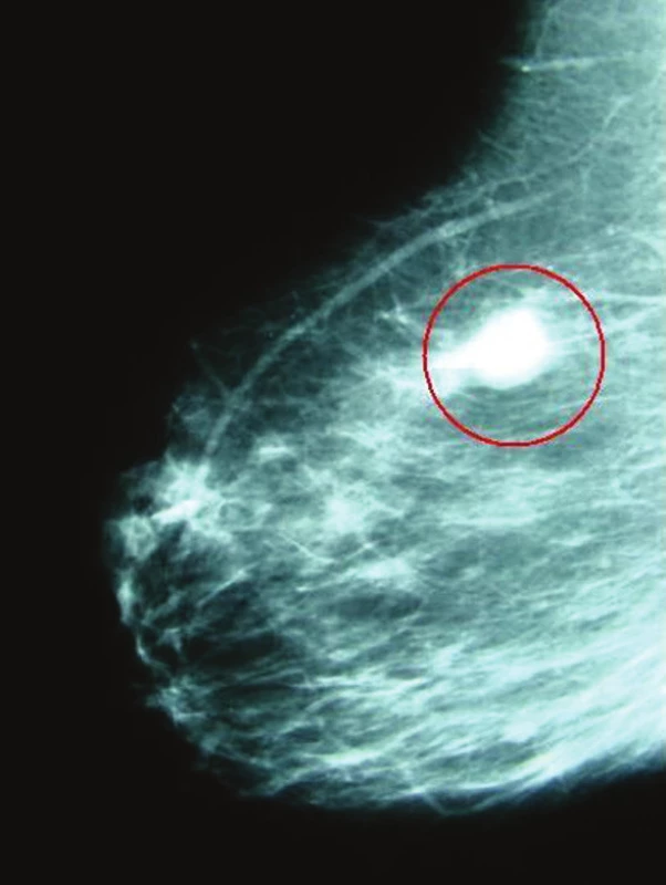 Invazivní duktuální karcinom prsu zobrazený na mamografii v šikmé projekci